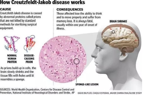 Schéma expliquant le mécanisme de la maladie de Creutzfeldt-Jakob